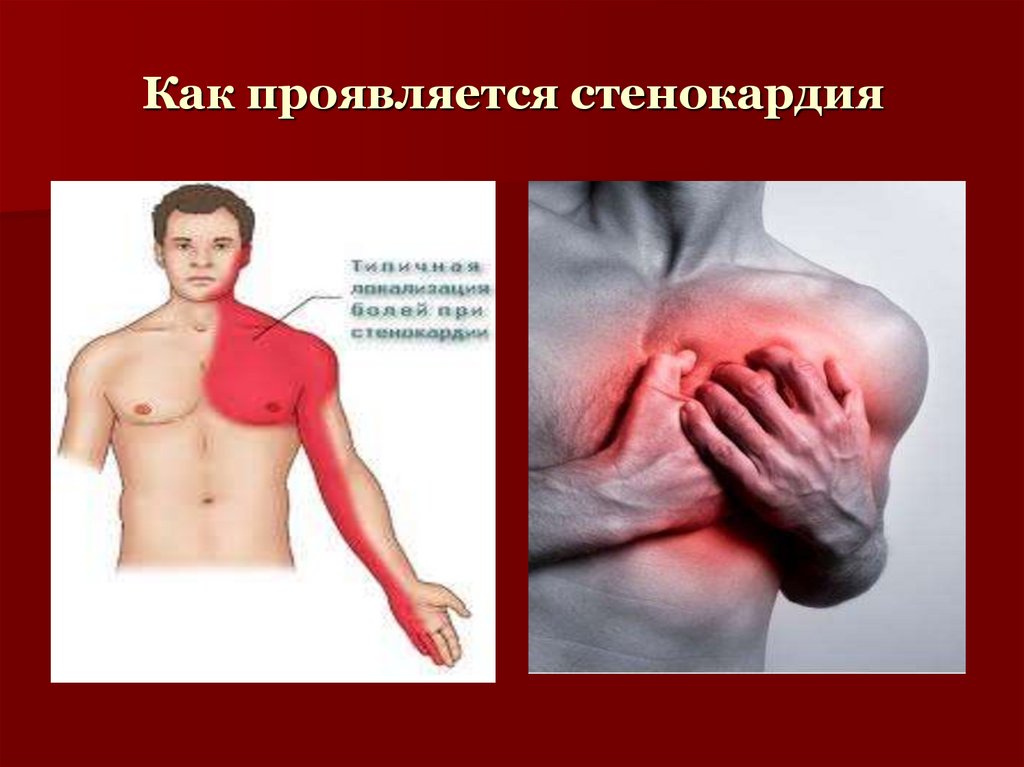 Как проявляется стенокардия