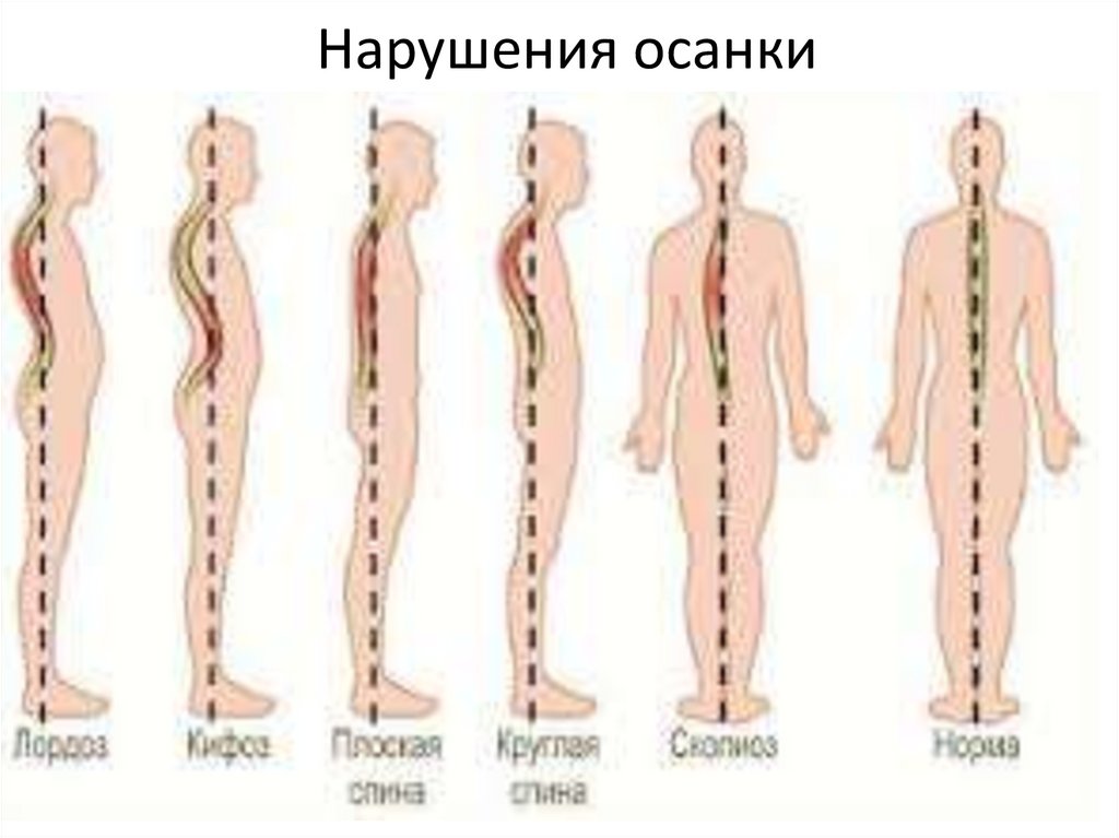 Нарушения осанки
