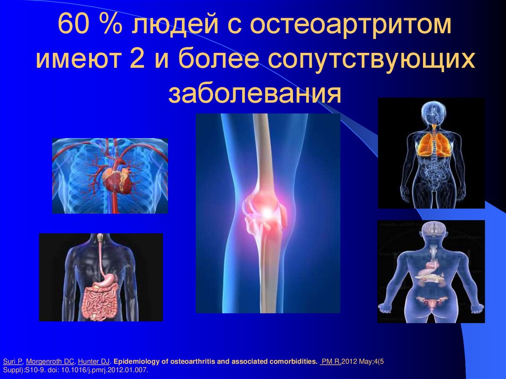 60 % людей с остеоартритом имеют 2 и более сопутствующих заболевания