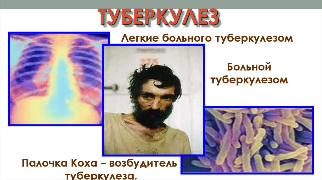 ТУБЕРКУЛЕЗ