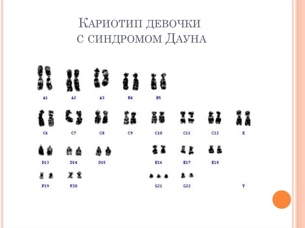 Кариотип девочки с синдромом Дауна
