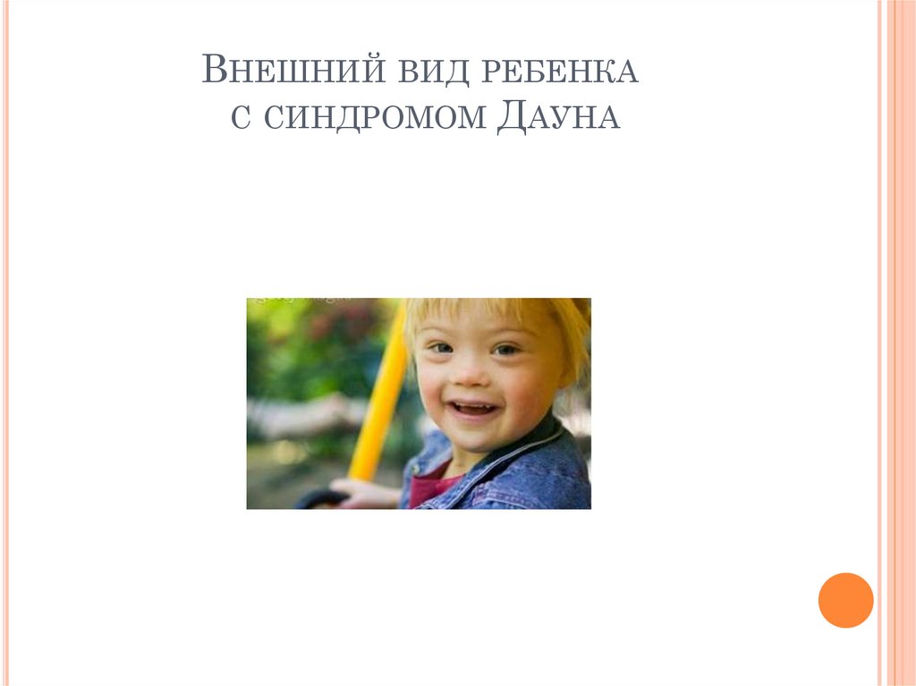 Внешний вид ребенка с синдромом Дауна