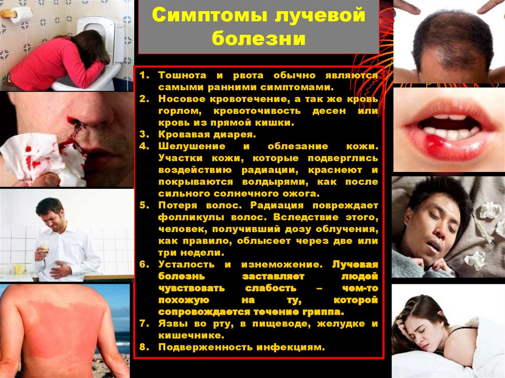 Симптомы лучевой болезни
