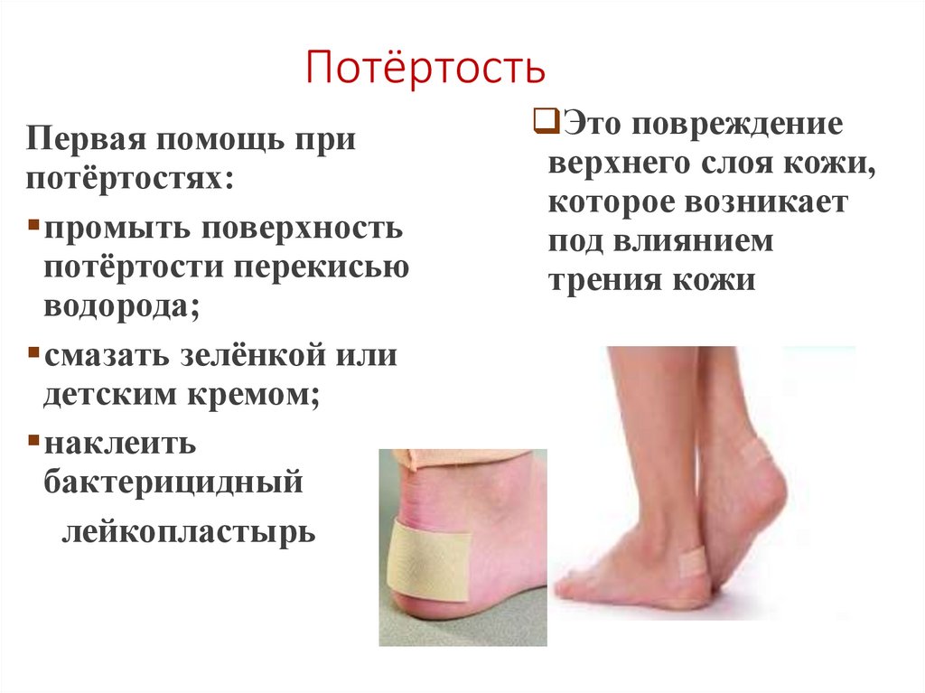 Потёртость
