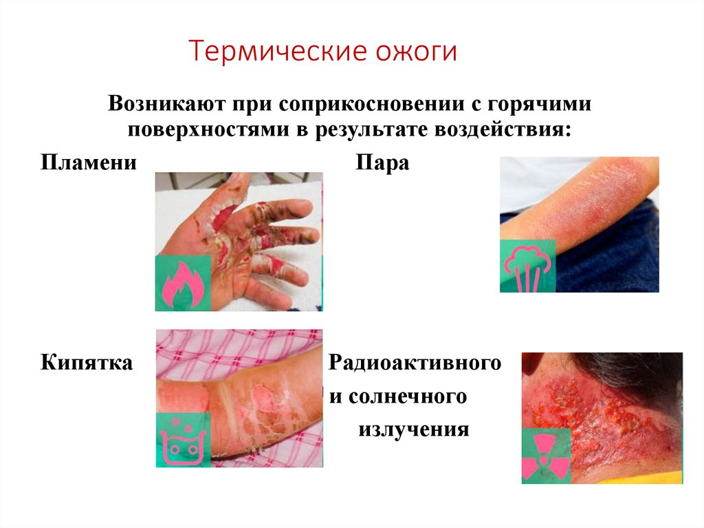 Термические ожоги