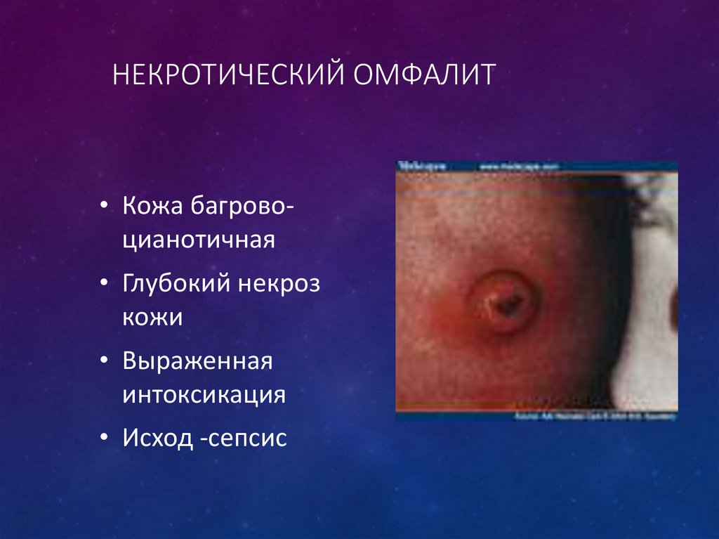 Некротический омфалит