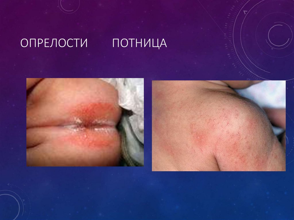 Опрелости Потница