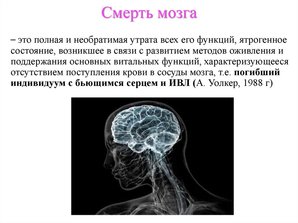 Смерть мозга