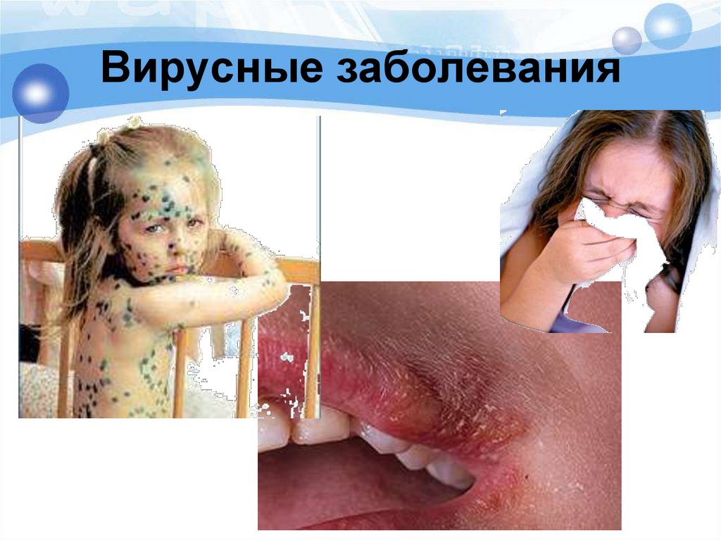 Вирусные заболевания