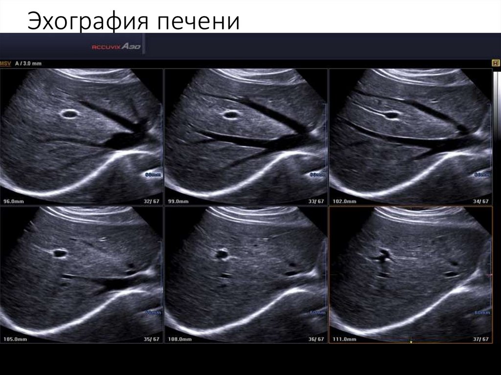 Эхография печени