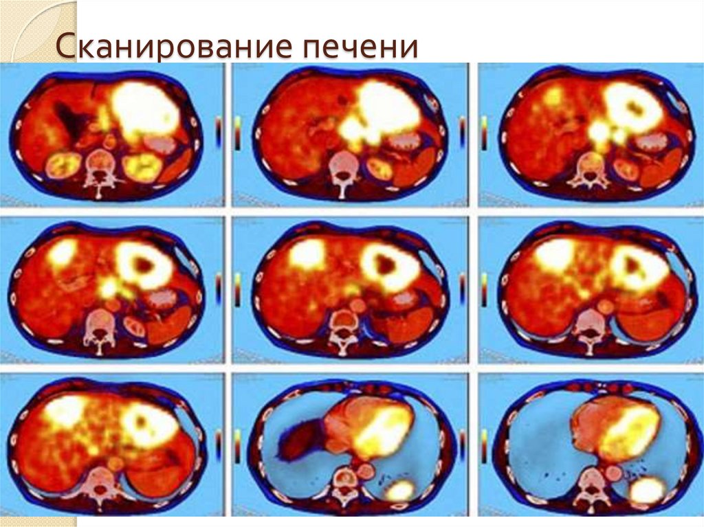 Сканирование печени