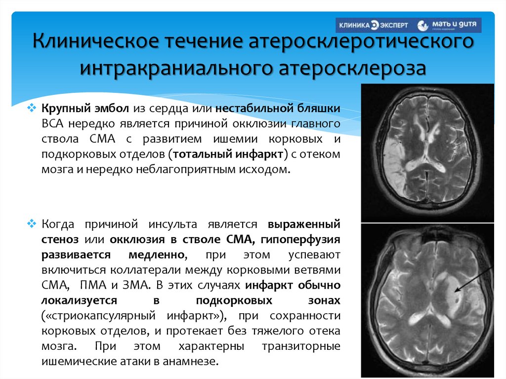 Клиническое течение атеросклеротического интракраниального атеросклероза