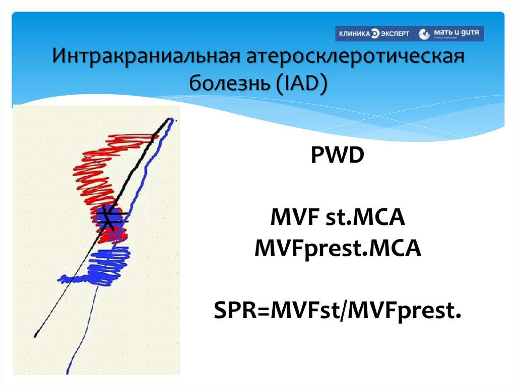 Интракраниальная атеросклеротическая болезнь (IAD)