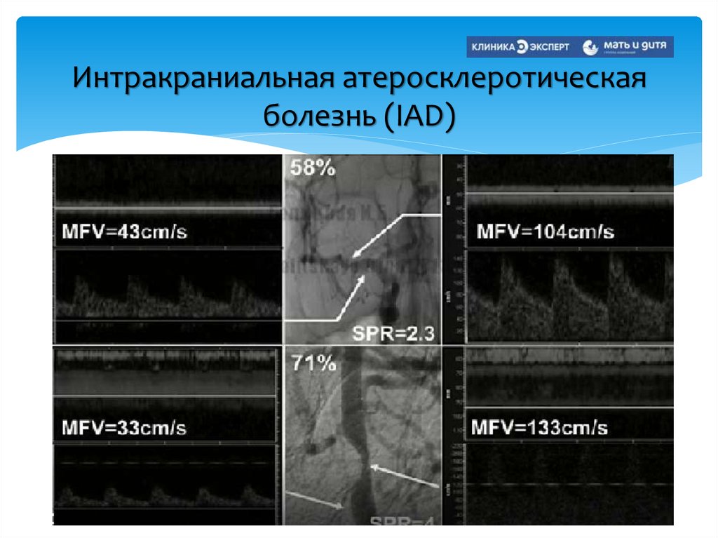 Интракраниальная атеросклеротическая болезнь (IAD)