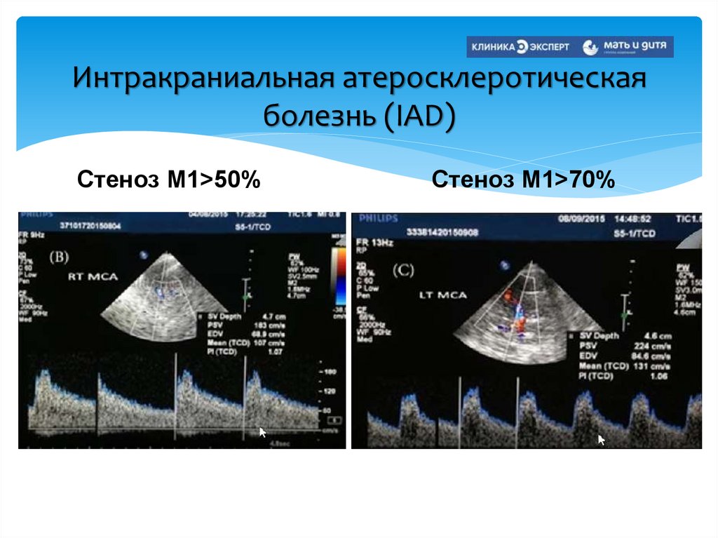 Интракраниальная атеросклеротическая болезнь (IAD)