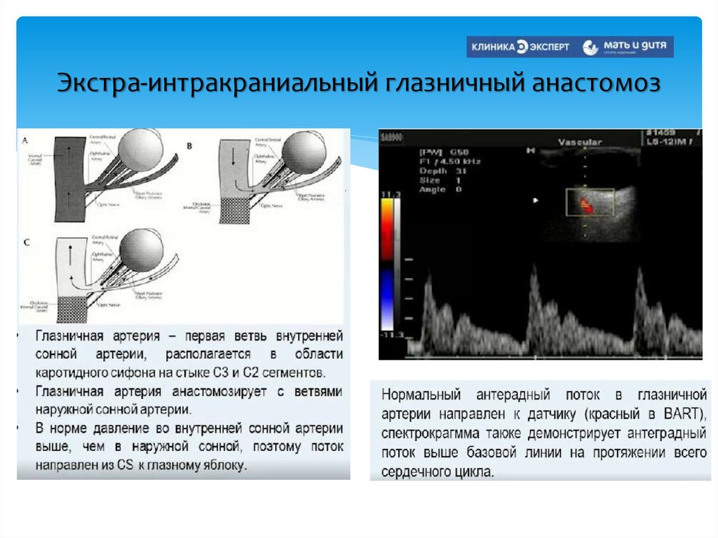 Экстра-интракраниальный глазничный анастомоз