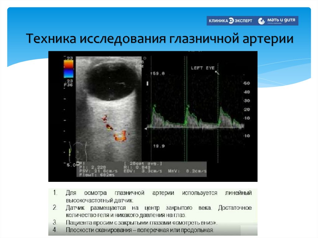 Техника исследования глазничной артерии
