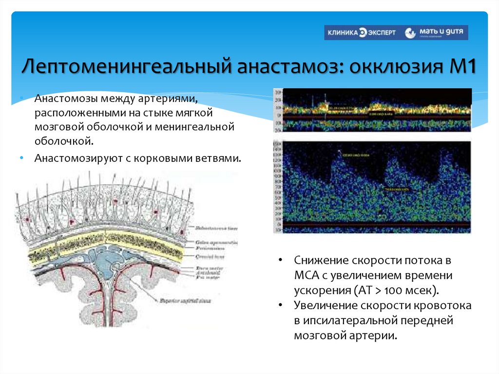 Лептоменингеальный анастамоз: окклюзия М1