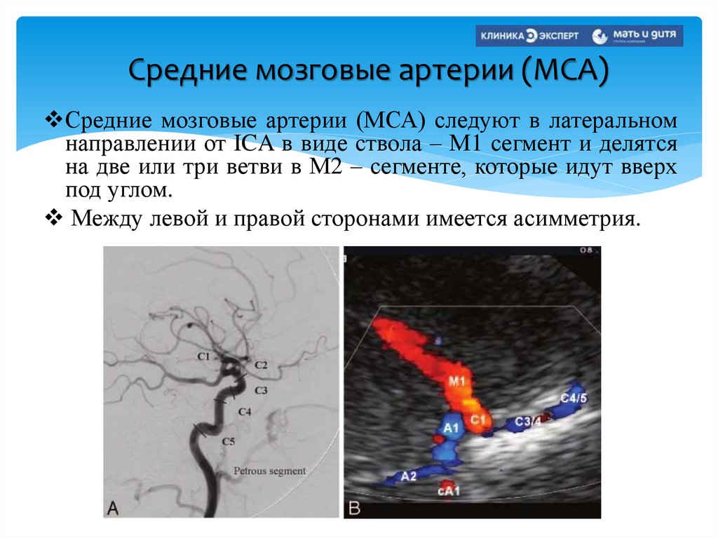 Средние мозговые артерии (МСА)