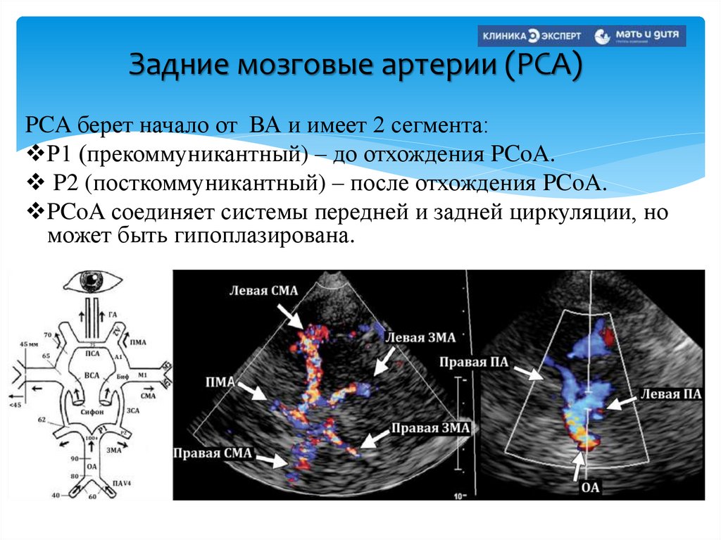 Задние мозговые артерии (PСА)