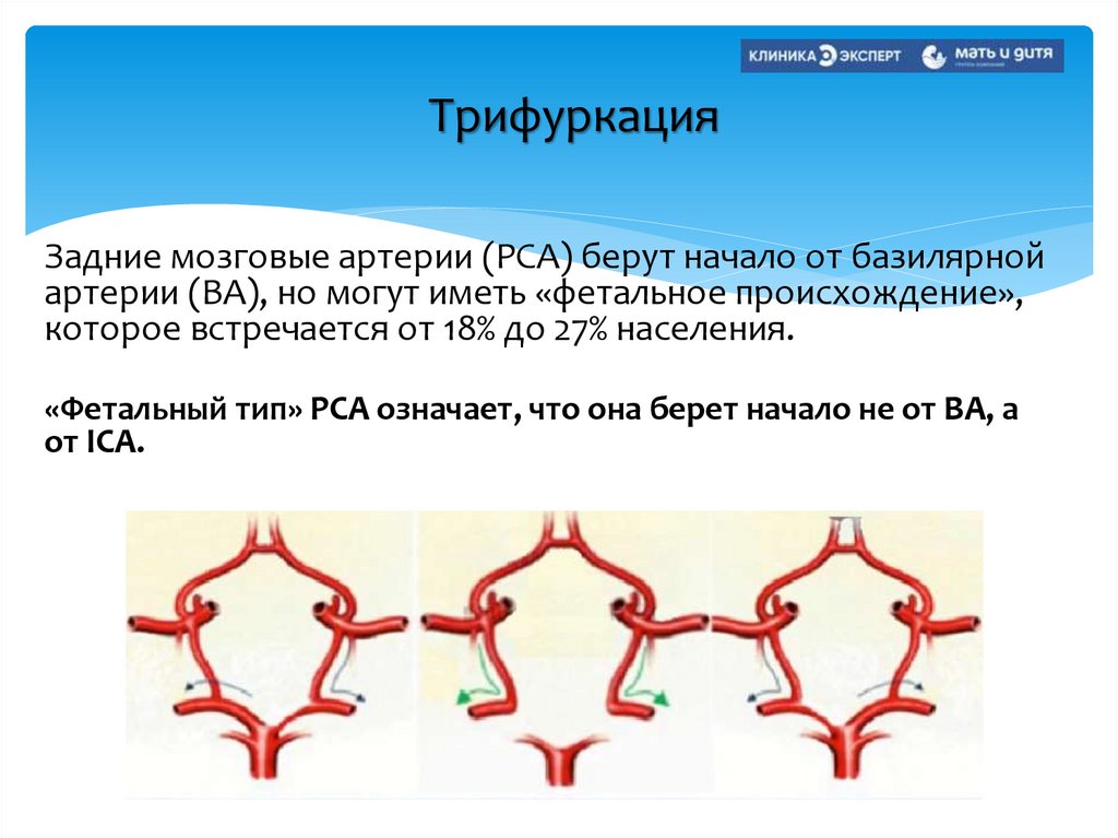 Трифуркация