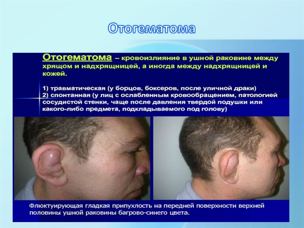 Отогематома