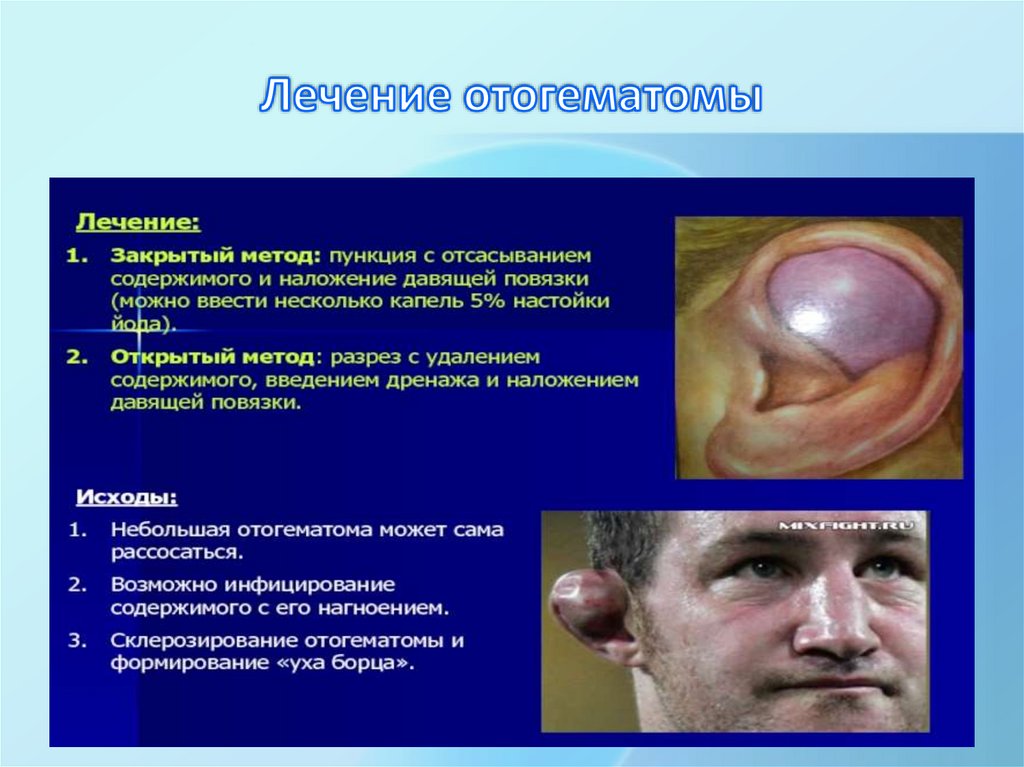 Лечение отогематомы