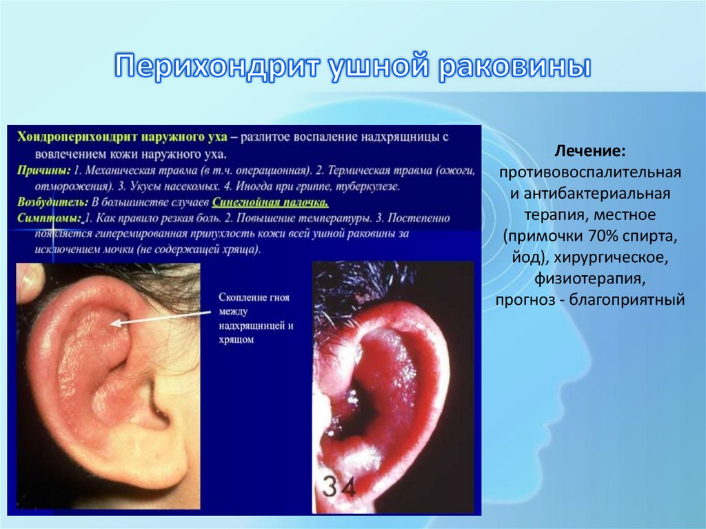 Перихондрит ушной раковины
