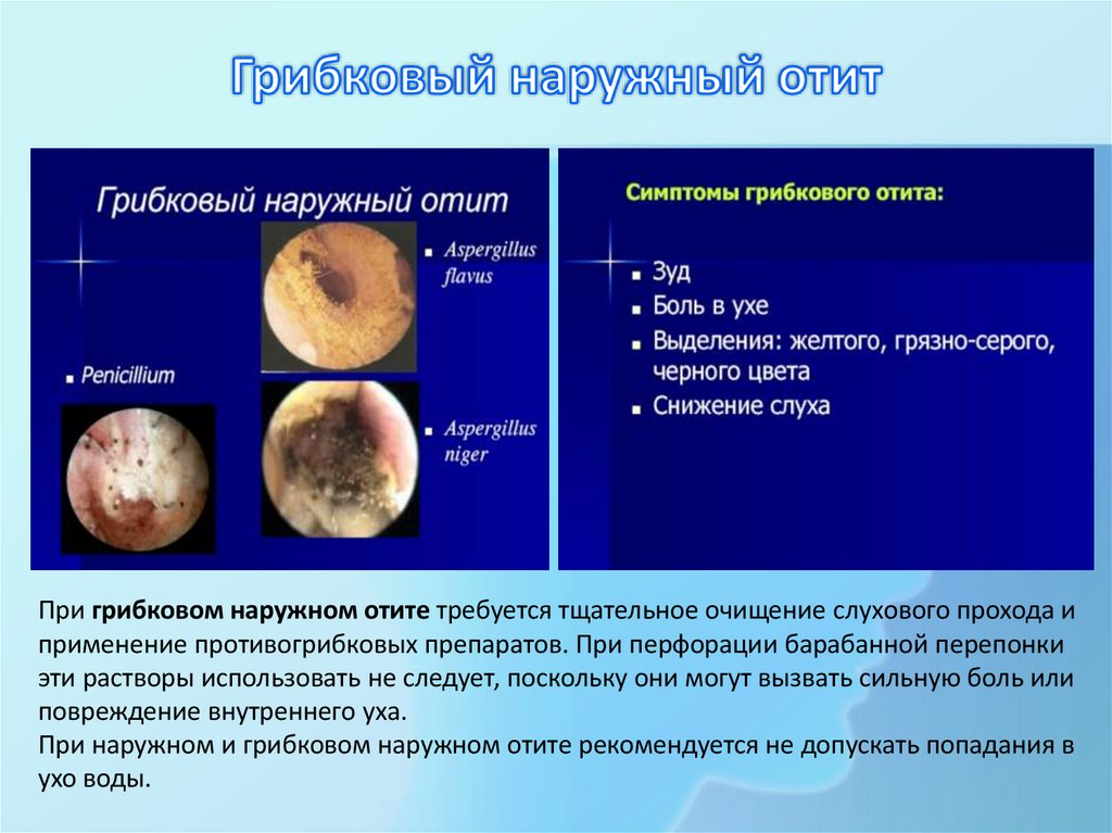 Грибковый наружный отит