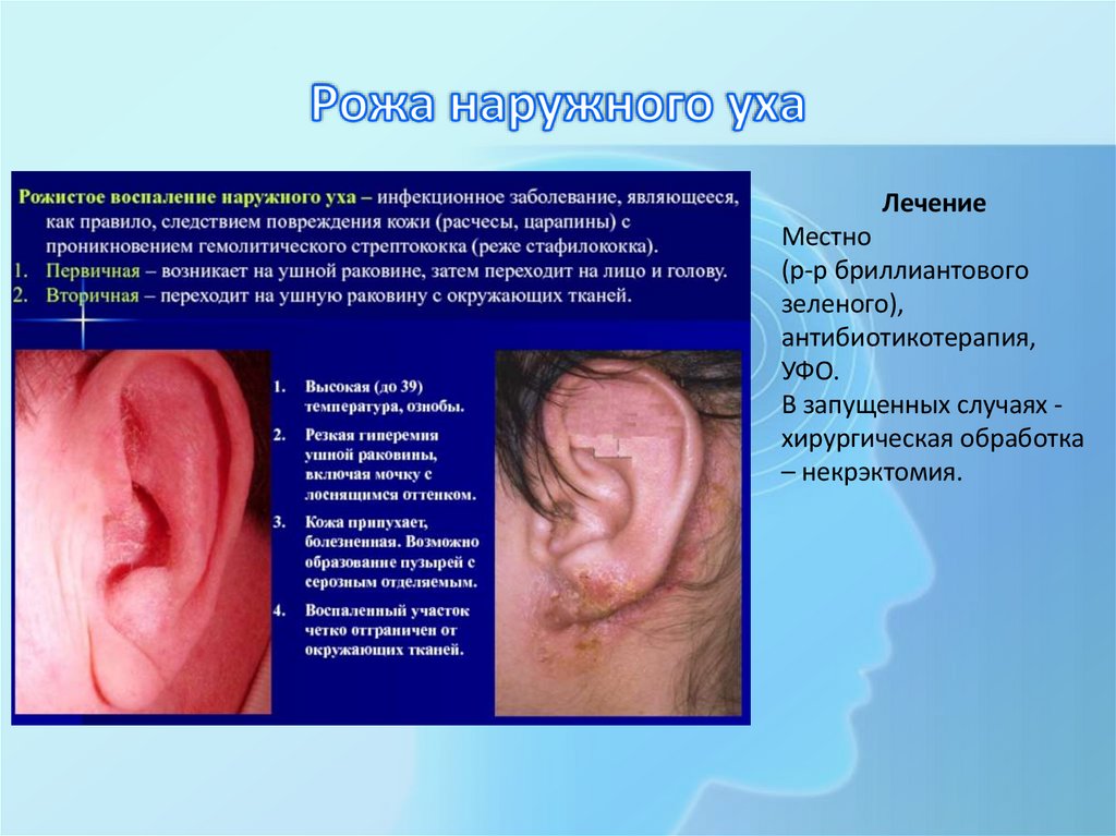 Рожа наружного уха