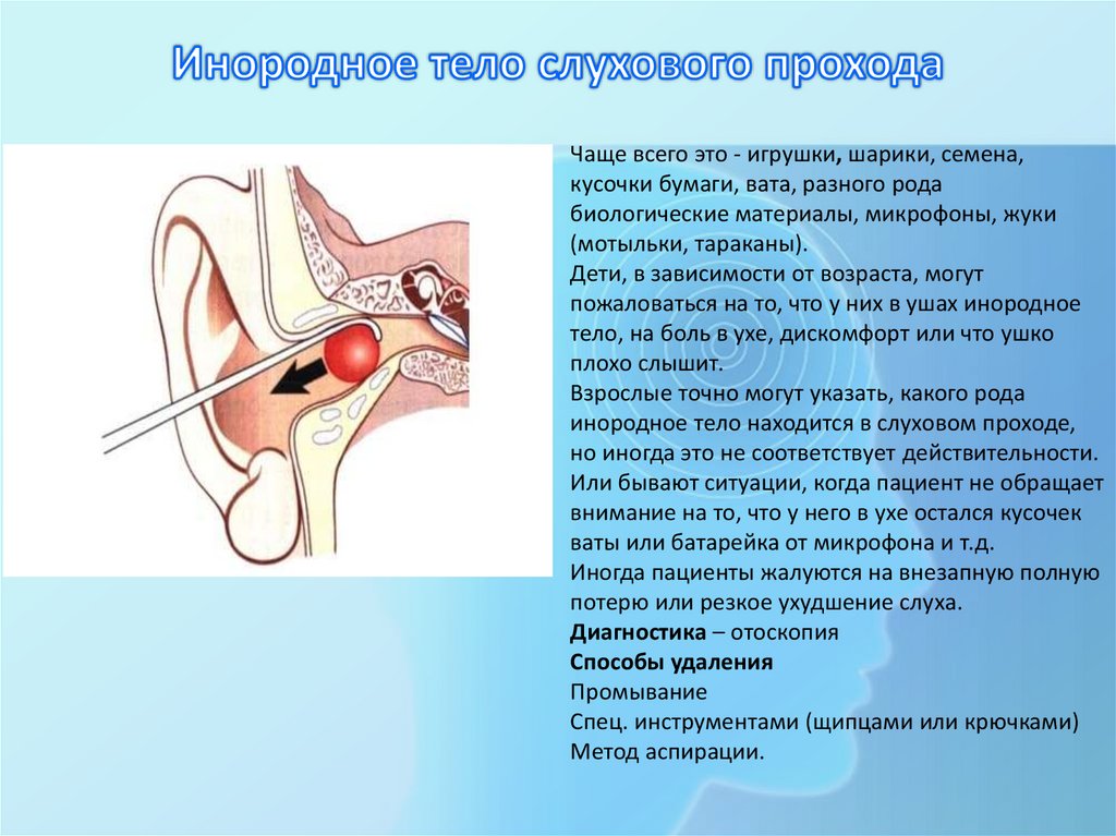 Инородное тело слухового прохода
