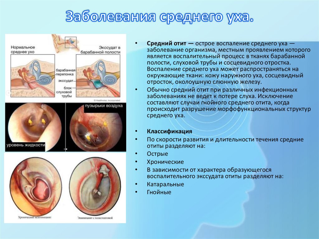 Заболевания среднего уха.