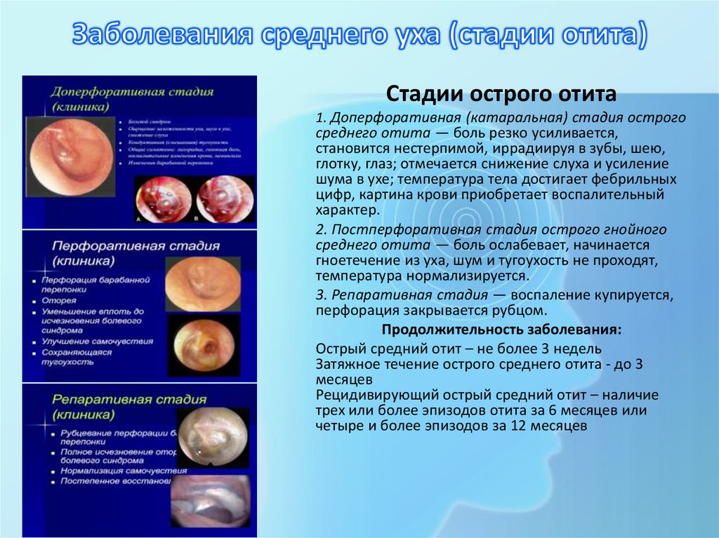 Заболевания среднего уха (стадии отита)