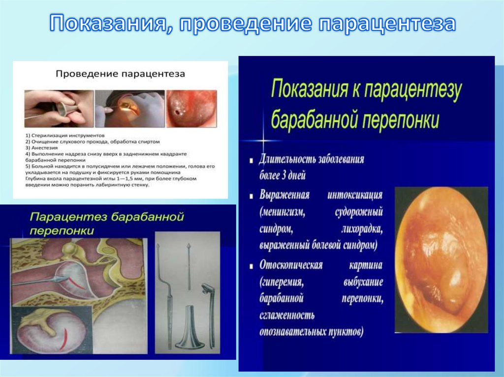 Показания, проведение парацентеза