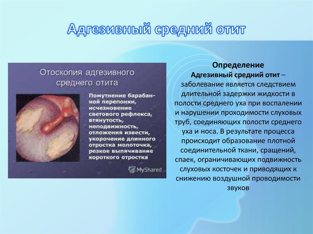 Адгезивный средний отит