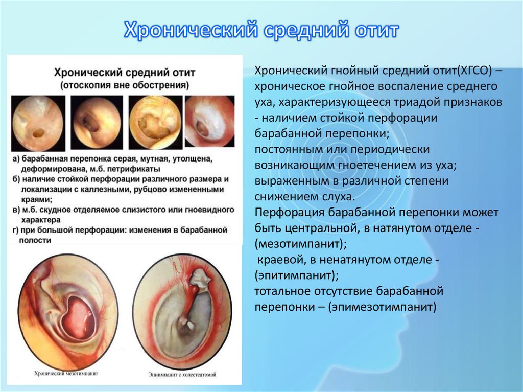 Хронический средний отит