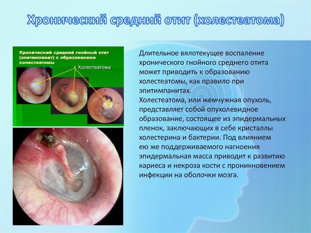 Хронический средний отит (холестеатома)