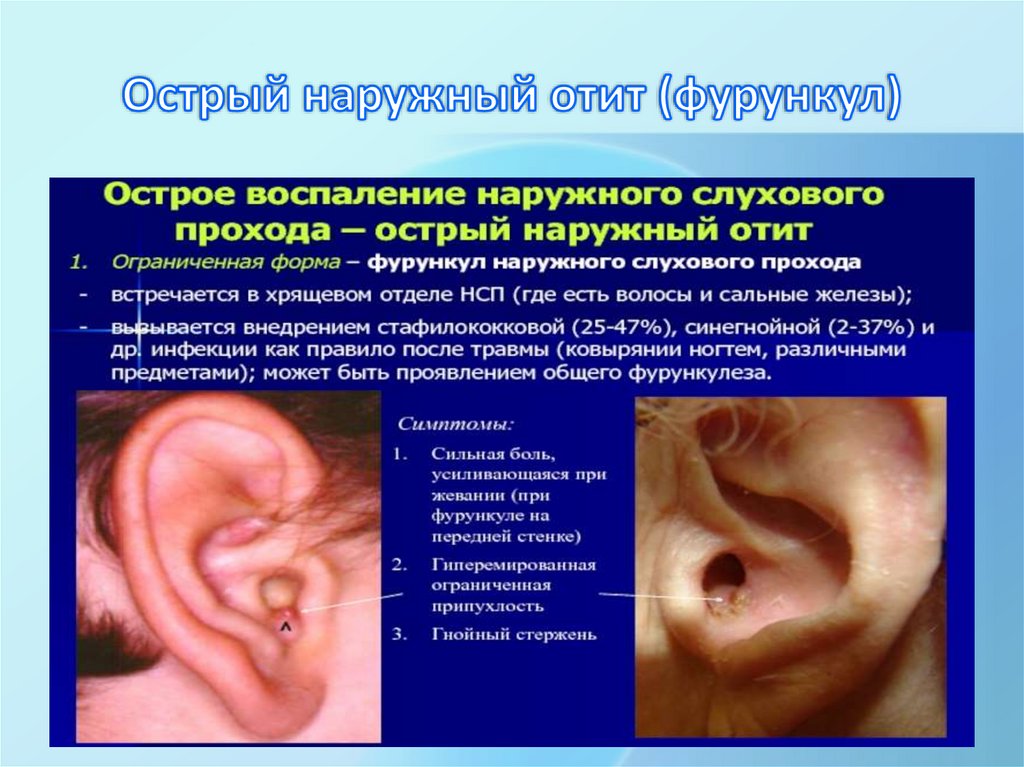 Острый наружный отит (фурункул)