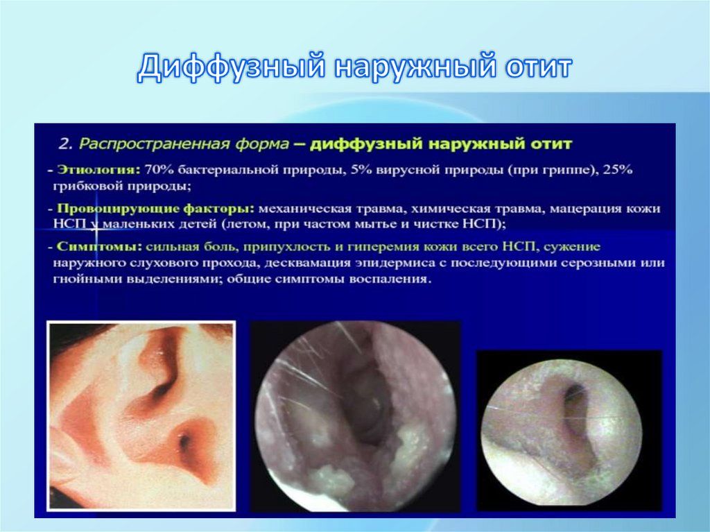Диффузный наружный отит