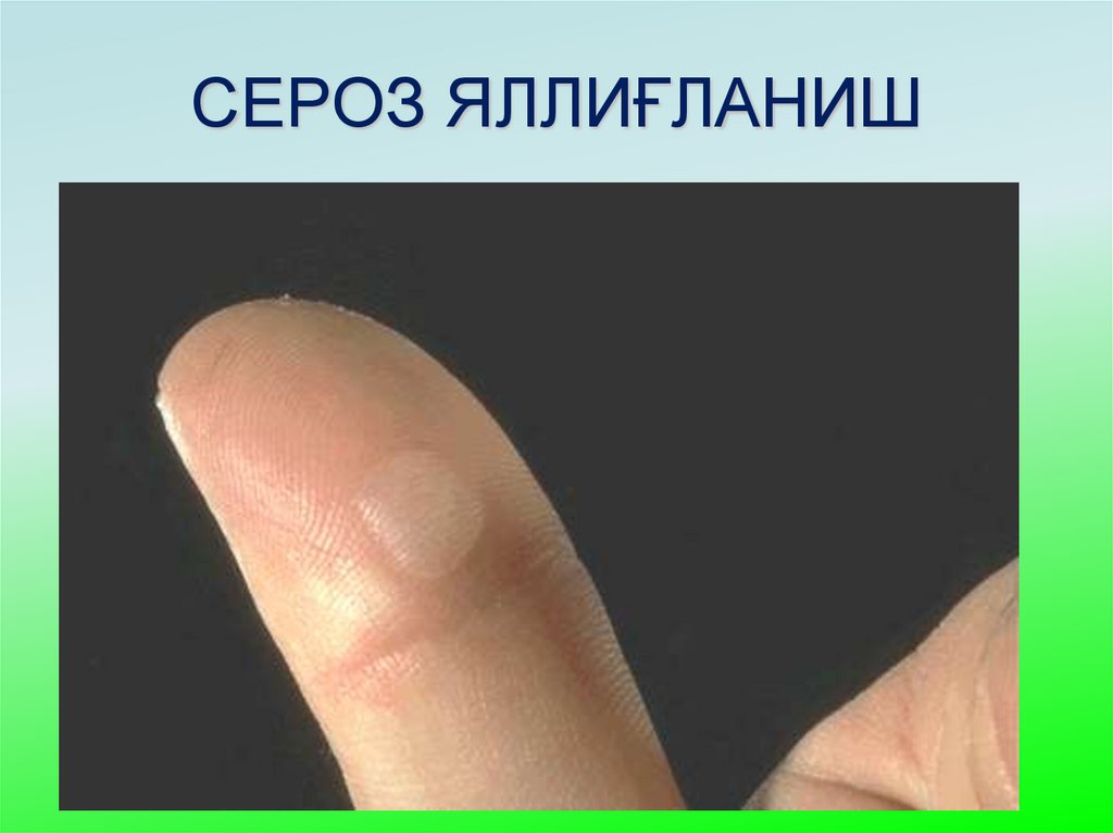 СЕРОЗ ЯЛЛИҒЛАНИШ