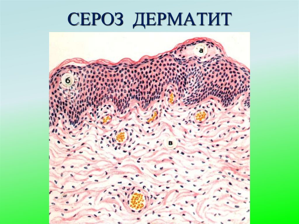СЕРОЗ ДЕРМАТИТ