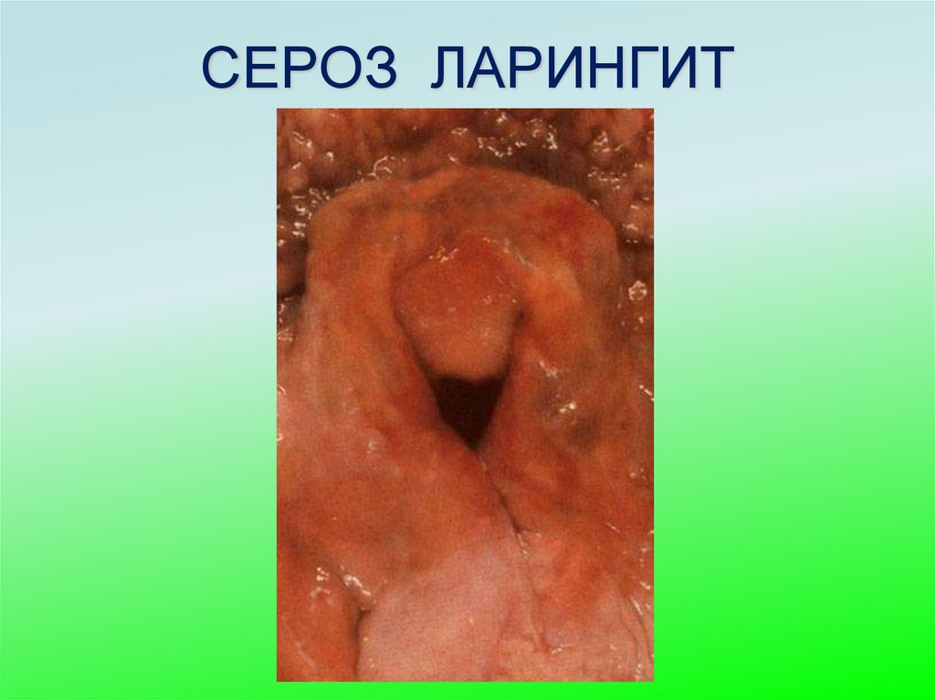 СЕРОЗ ЛАРИНГИТ