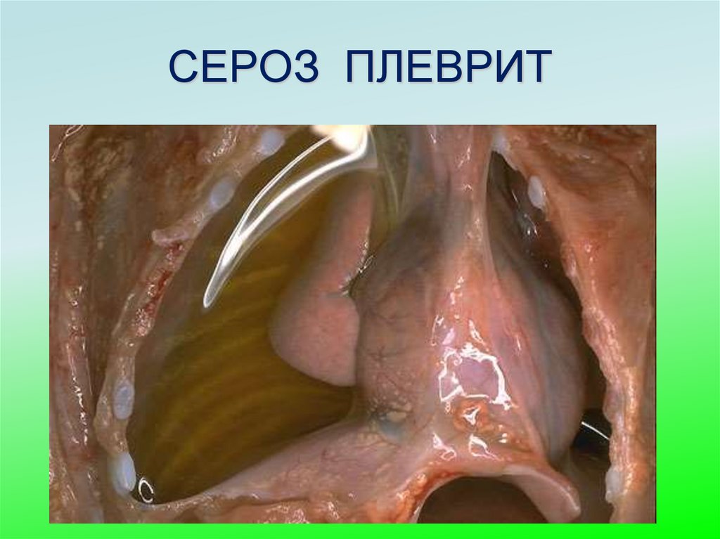 СЕРОЗ ПЛЕВРИТ