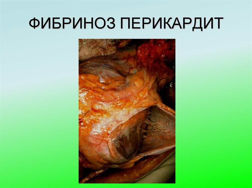 ФИБРИНОЗ ПЕРИКАРДИТ