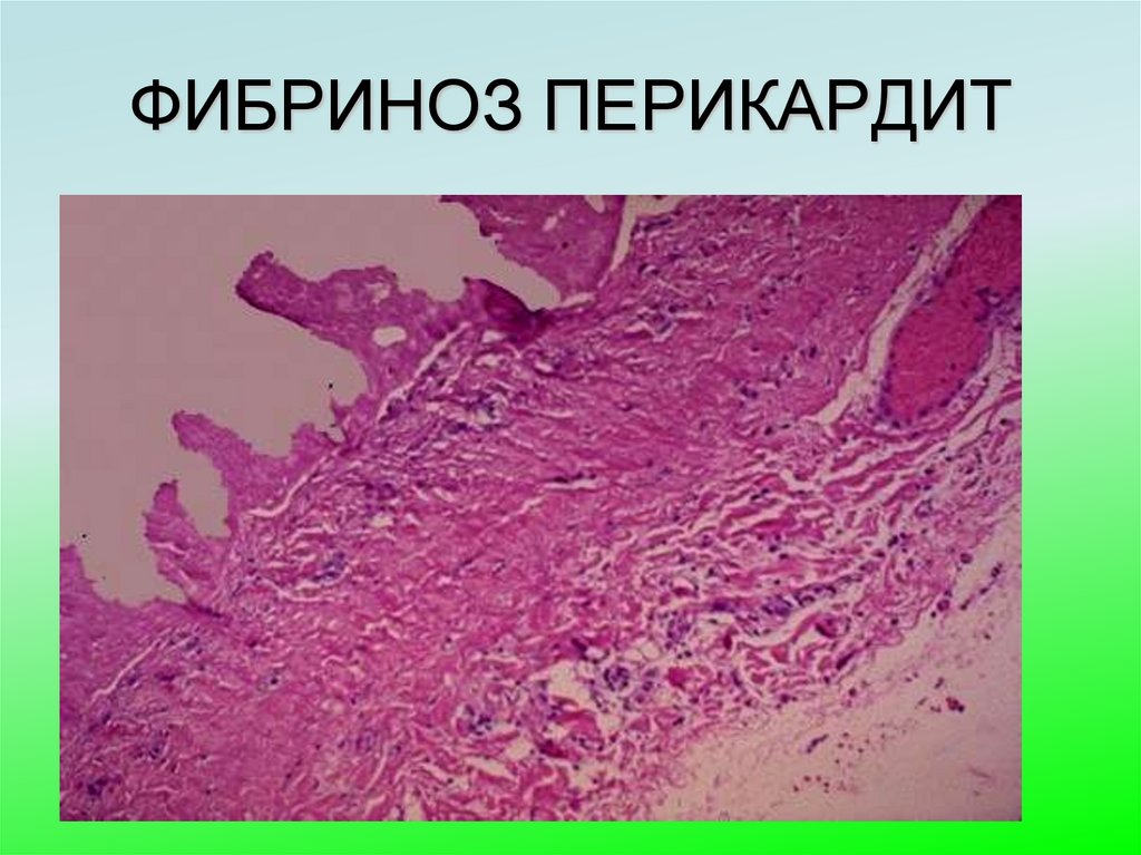 ФИБРИНОЗ ПЕРИКАРДИТ