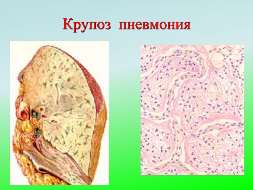 Крупоз пневмония