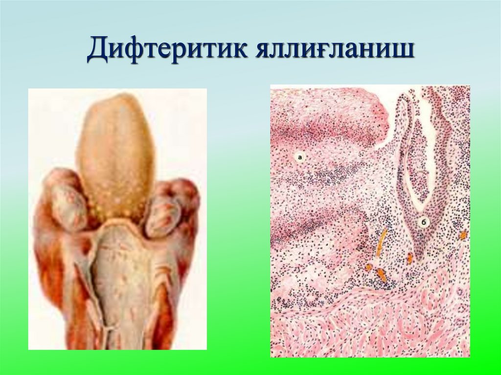 Дифтеритик яллиғланиш