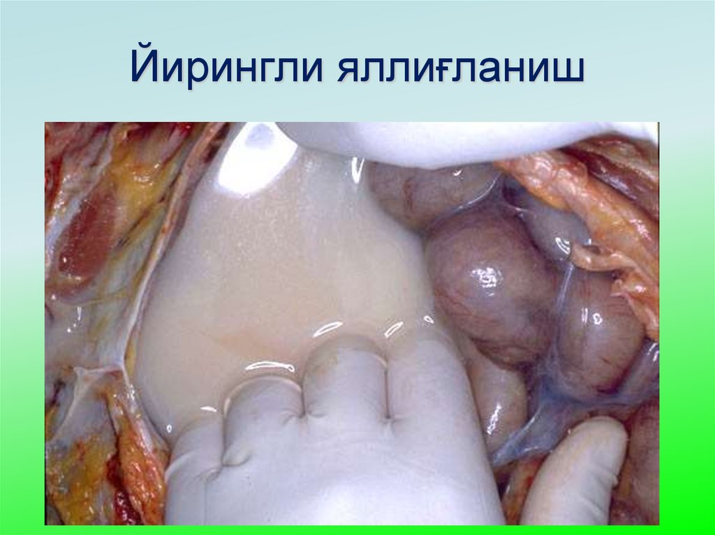 Йирингли яллиғланиш