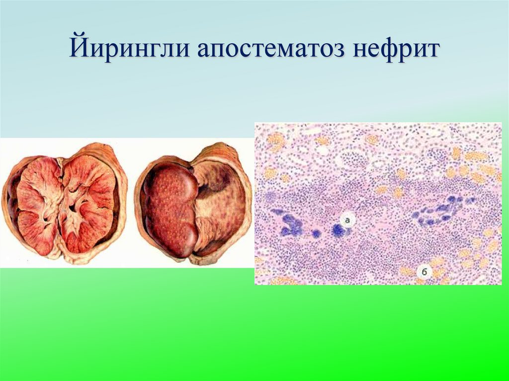 Йирингли апостематоз нефрит