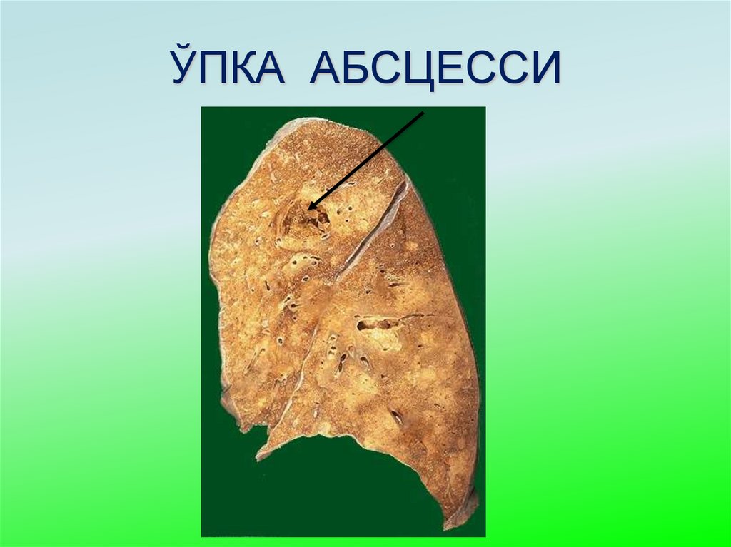 ЎПКА АБСЦЕССИ